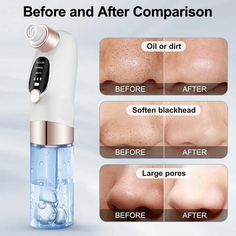 Blackhead Remover Pore Vacuum Cleaner Face Black Dot Pimple Acne